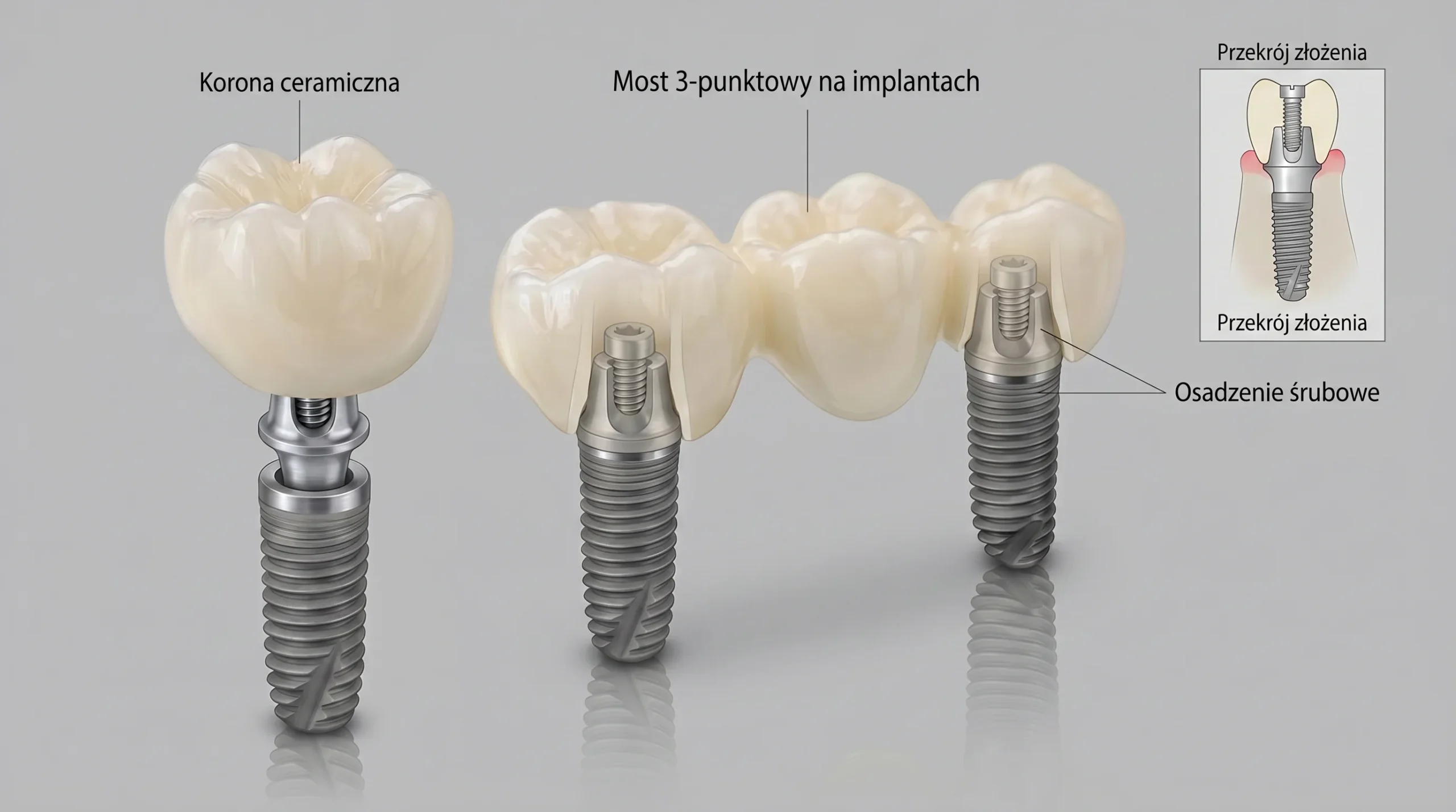 Nowoczesne uzupełnienia protetyczne: korona i most na implantach