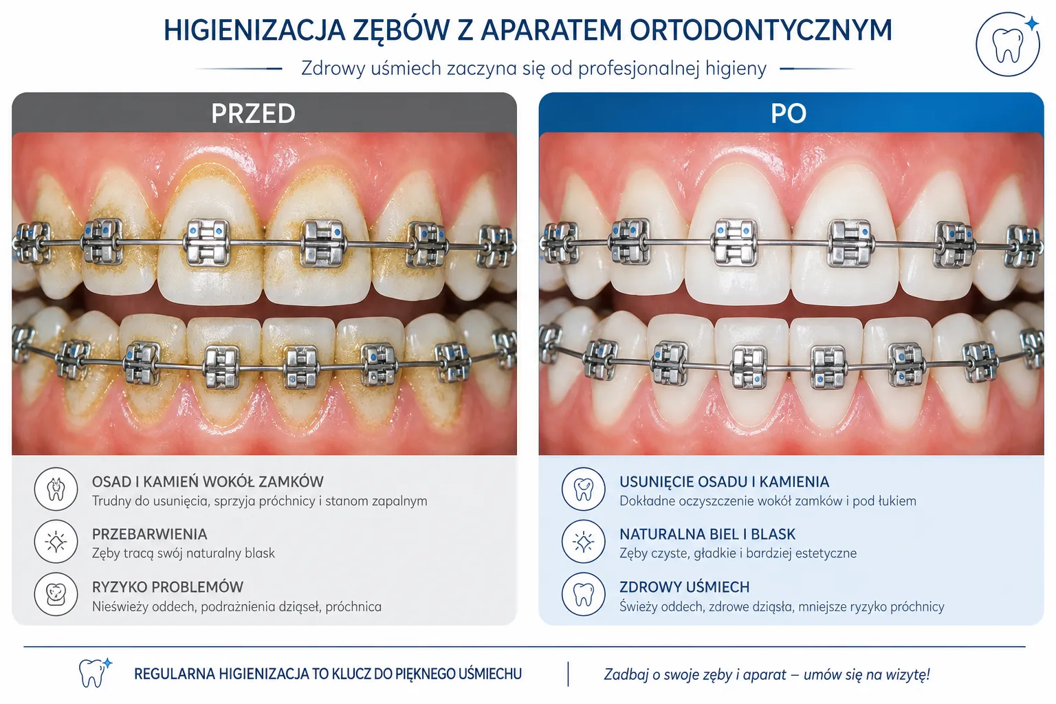 Porównanie zębów przed i po profesjonalnej higienizacji z aparatem ortodontycznym