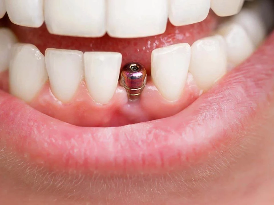 Implantologia stomatologiczna – implant zęba